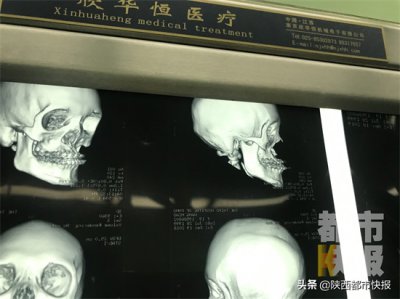 ​眼球突出手术 厉害了！女孩眼球先天性凸出，医生用VR给患者手术