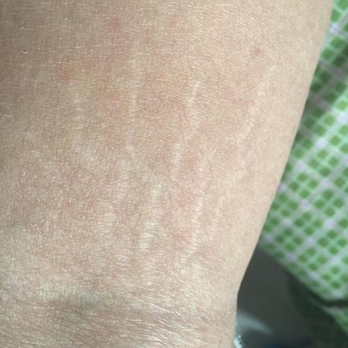 生长纹怎么去除(去除生长纹方法)